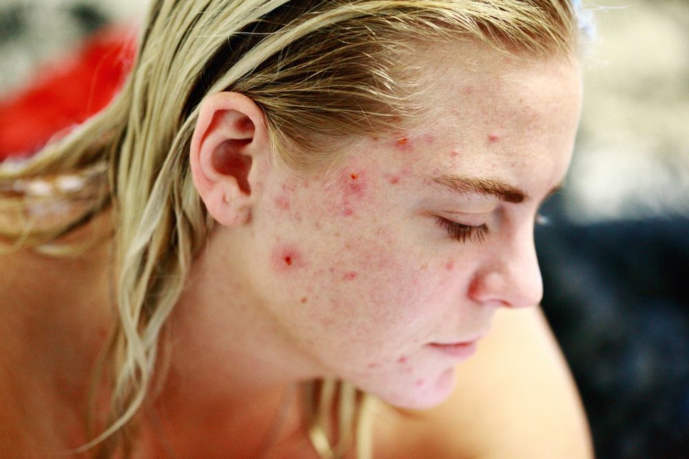 Akne behandling - Få en klar og strålende hud med riktig behandling!